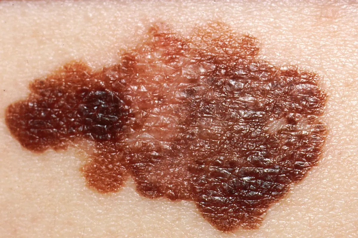 Dermatolozi na Žnjanu: Pregledi kože otkrili sumnjive promjene