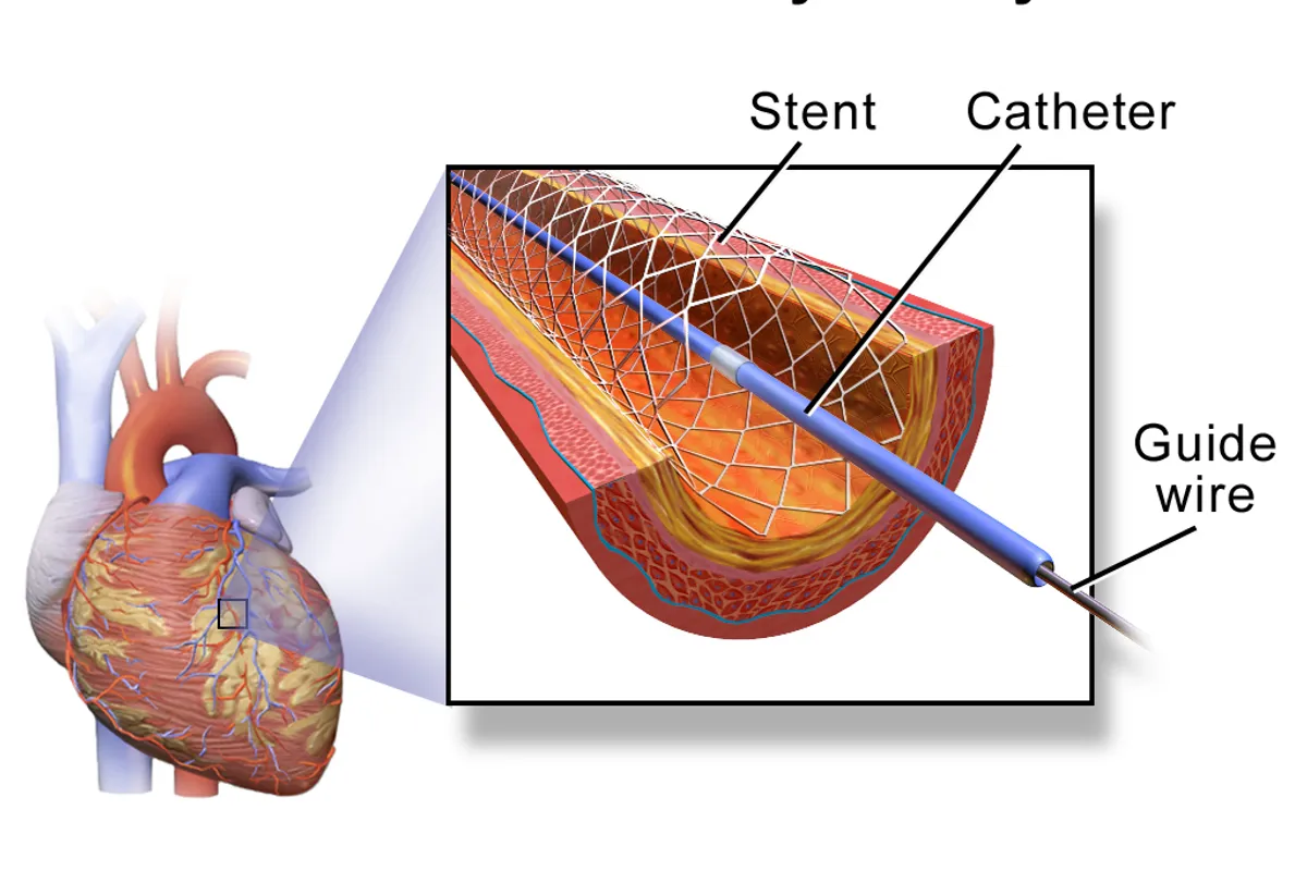 Dubrovnik Introduces New Method for the Most Severe Heart Patients